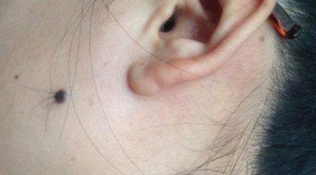 你有癌前病变吗？对照10种情况，一定要提高警惕